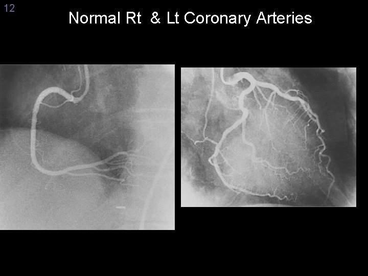 12 Normal Rt & Lt Coronary Arteries 