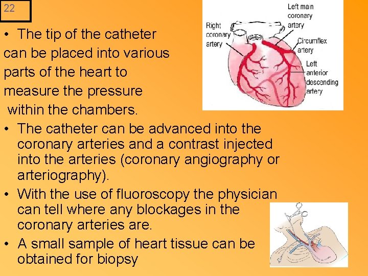 22 • The tip of the catheter can be placed into various parts of