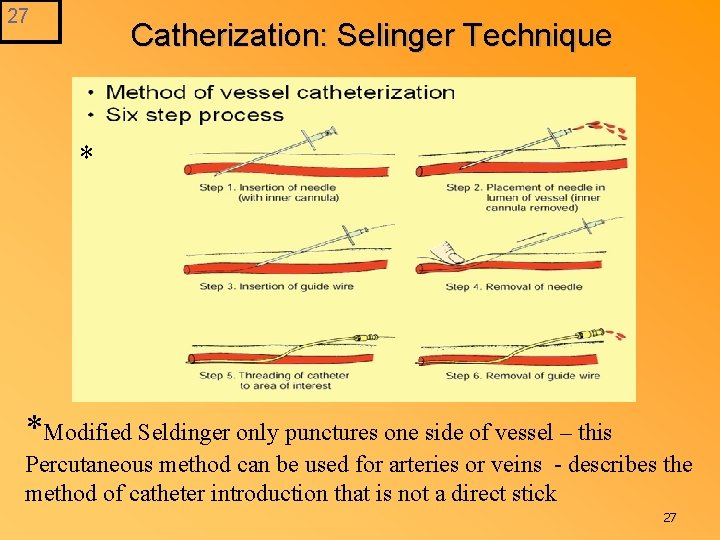 27 Catherization: Selinger Technique * *Modified Seldinger only punctures one side of vessel –