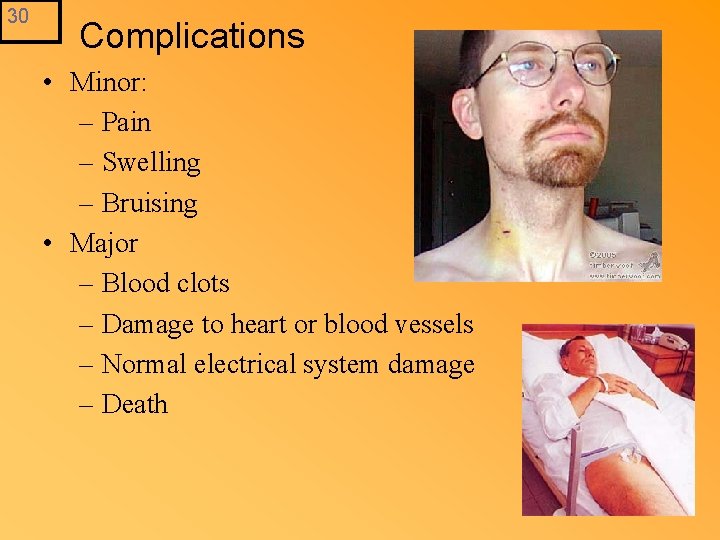 30 Complications • Minor: – Pain – Swelling – Bruising • Major – Blood