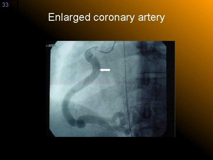 33 Enlarged coronary artery 