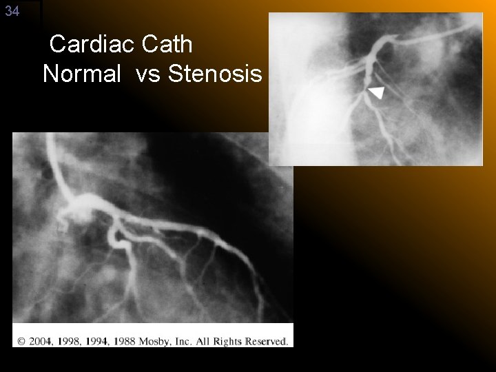 34 Cardiac Cath Normal vs Stenosis 