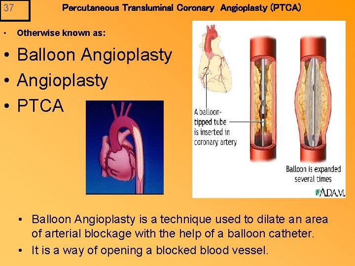 37 • Percutaneous Transluminal Coronary Angioplasty (PTCA) Otherwise known as: • Balloon Angioplasty •