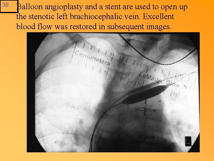 39 Balloon angioplasty and a stent are used to open up the stenotic left