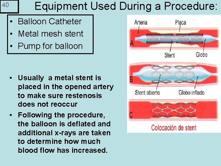 40 Equipment Used During a Procedure: • Balloon Catheter • Metal mesh stent •