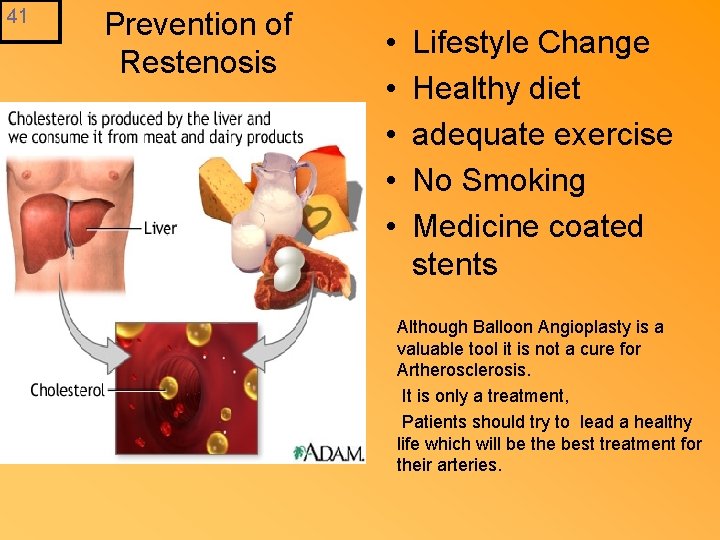 41 Prevention of Restenosis • • • Lifestyle Change Healthy diet adequate exercise No