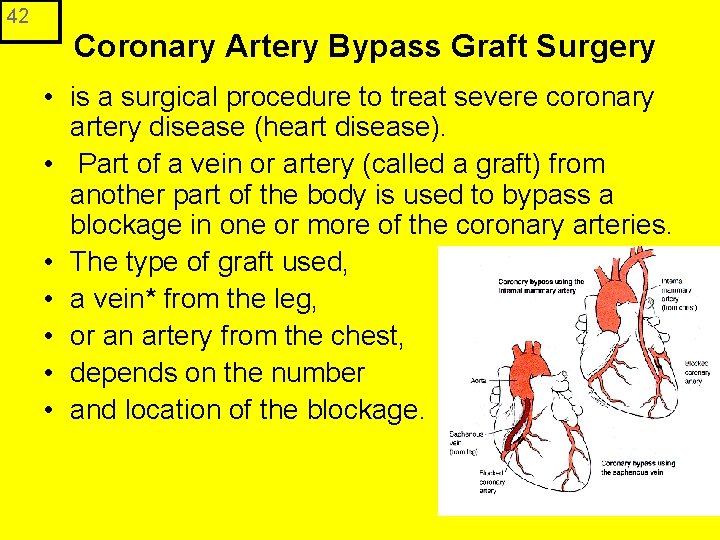 42 Coronary Artery Bypass Graft Surgery • is a surgical procedure to treat severe