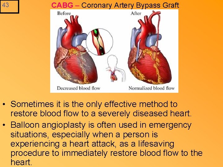 43 CABG – Coronary Artery Bypass Graft • Sometimes it is the only effective