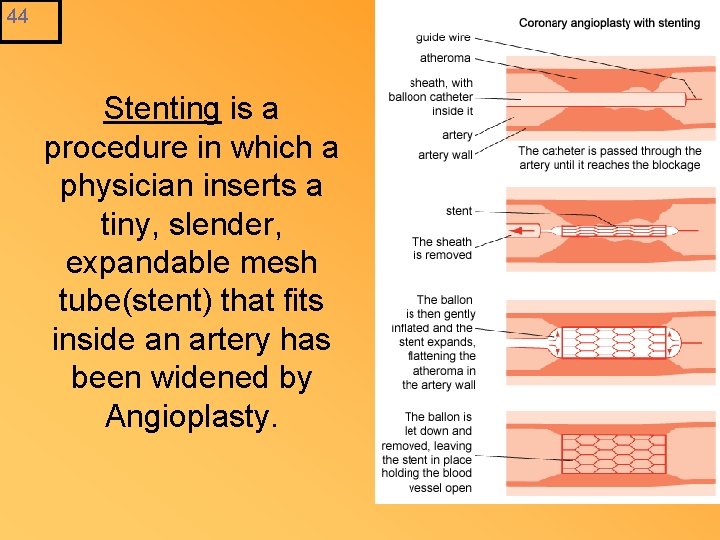 44 Stenting is a procedure in which a physician inserts a tiny, slender, expandable