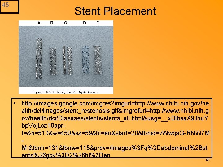 45 Stent Placement • http: //images. google. com/imgres? imgurl=http: //www. nhlbi. nih. gov/he alth/dci/images/stent_restenosis.