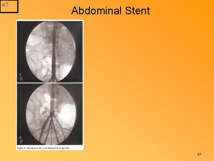 47 Abdominal Stent 47 