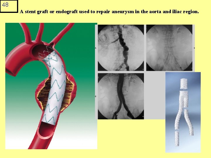48 A stent graft or endograft used to repair aneurysm in the aorta and