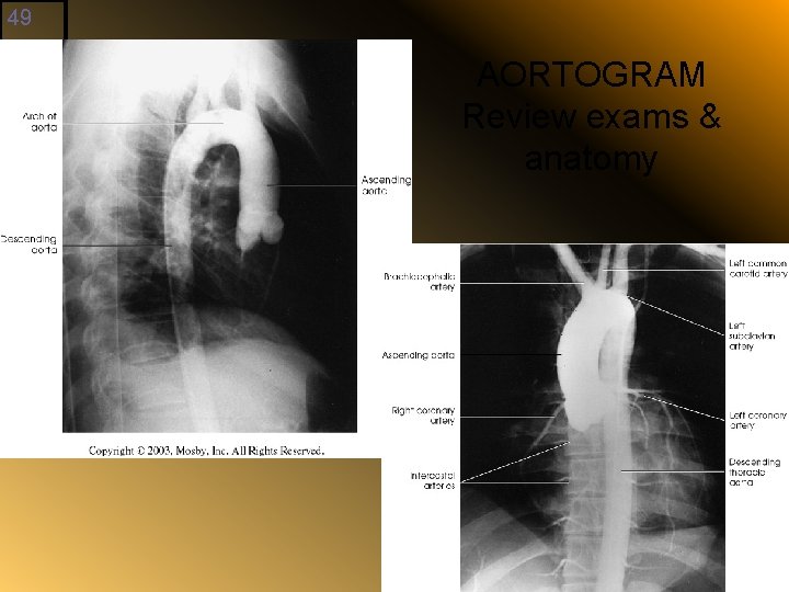 49 AORTOGRAM Review exams & anatomy 