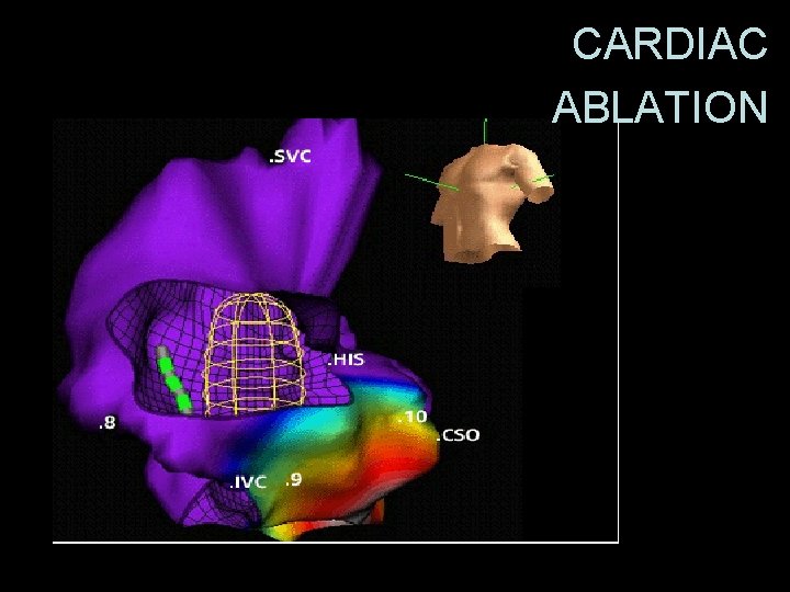 54 CARDIAC ABLATION Cardiac Ablation 