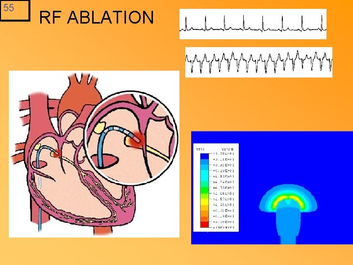 55 RF ABLATION 