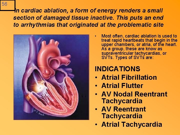 56 In cardiac ablation, a form of energy renders a small section of damaged