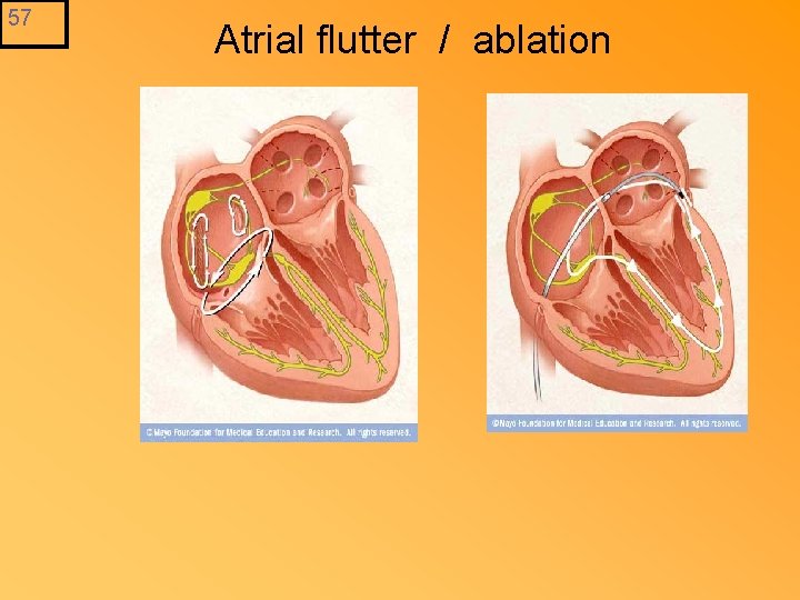 57 Atrial flutter / ablation 