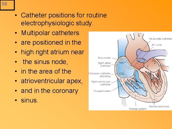 59 • Catheter positions for routine electrophysiologic study. • Multipolar catheters • are positioned