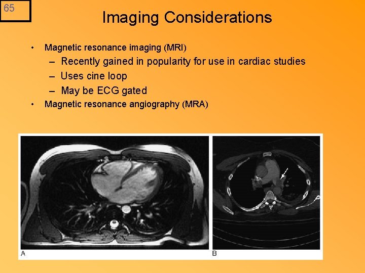 65 Imaging Considerations • Magnetic resonance imaging (MRI) – Recently gained in popularity for