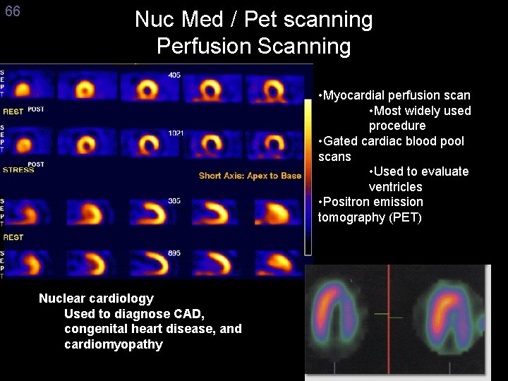 66 Nuc Med / Pet scanning Perfusion Scanning • Myocardial perfusion scan • Most