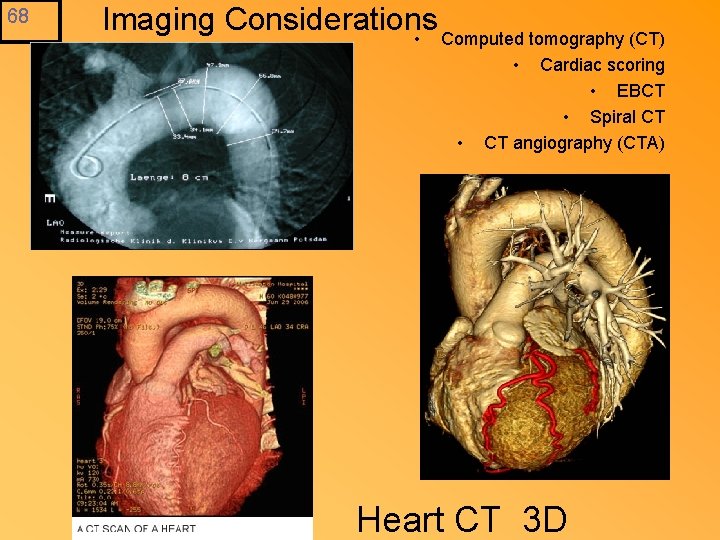 68 Imaging Considerations • Computed tomography (CT) • • Cardiac scoring • EBCT •