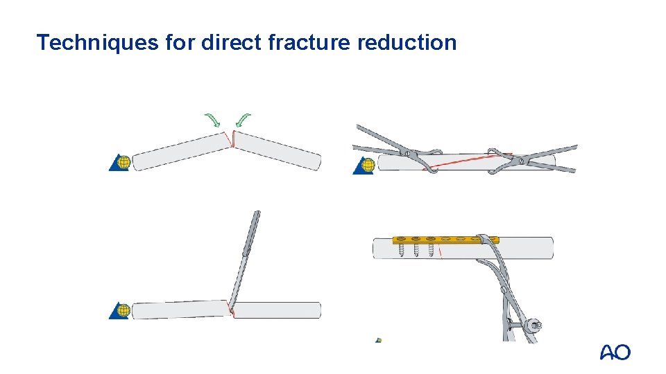 Techniques for direct fracture reduction 