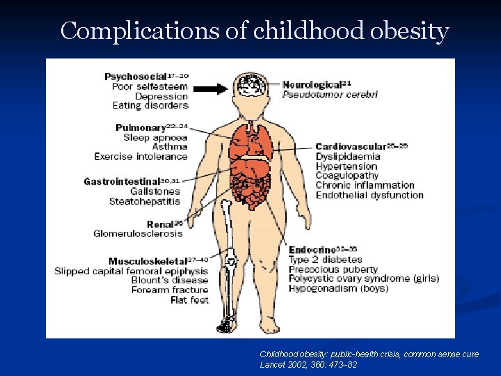 Complications of childhood obesity Childhood obesity: public-health crisis, common sense cure Lancet 2002, 360: