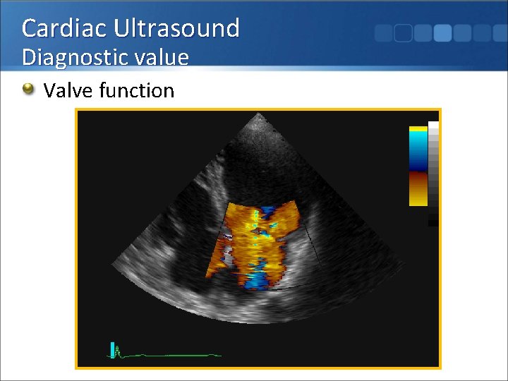 Cardiac Ultrasound Diagnostic value Valve function 