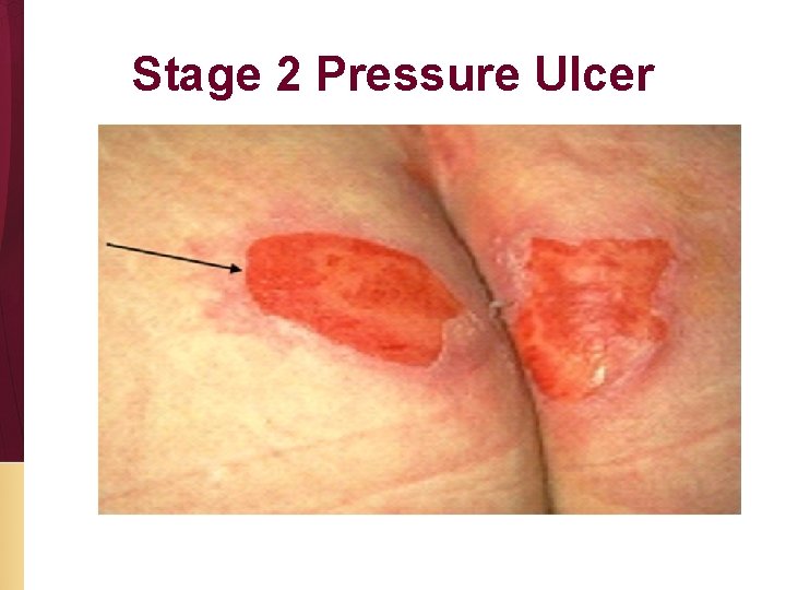 Stage 2 Pressure Ulcer 