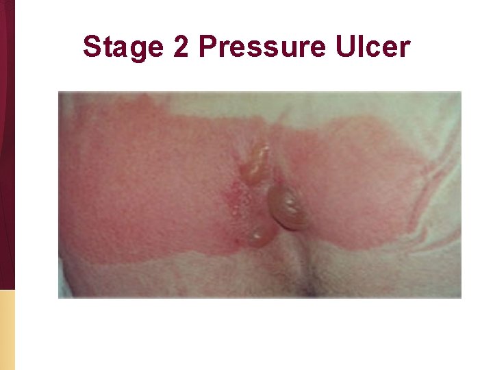 Stage 2 Pressure Ulcer 