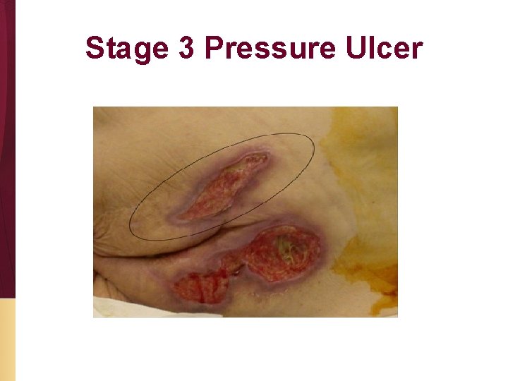 Stage 3 Pressure Ulcer 