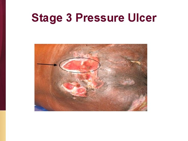Stage 3 Pressure Ulcer 