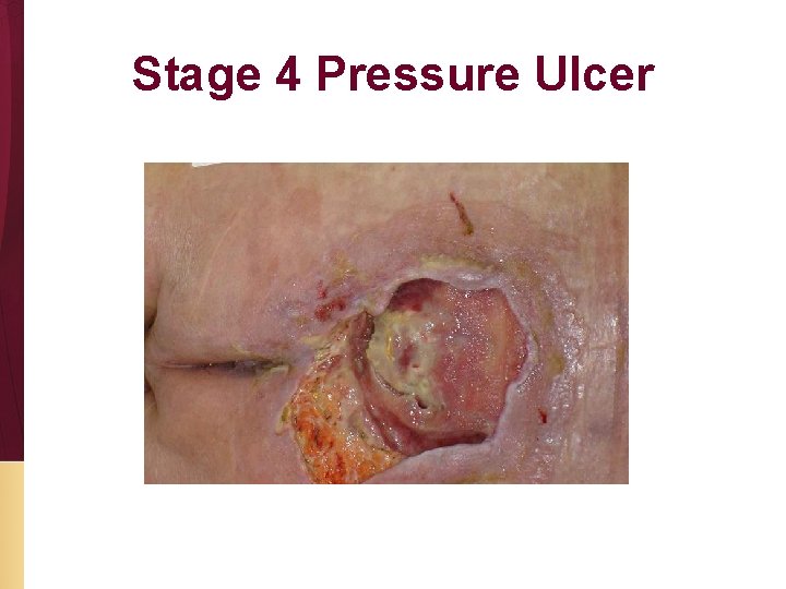 Stage 4 Pressure Ulcer 