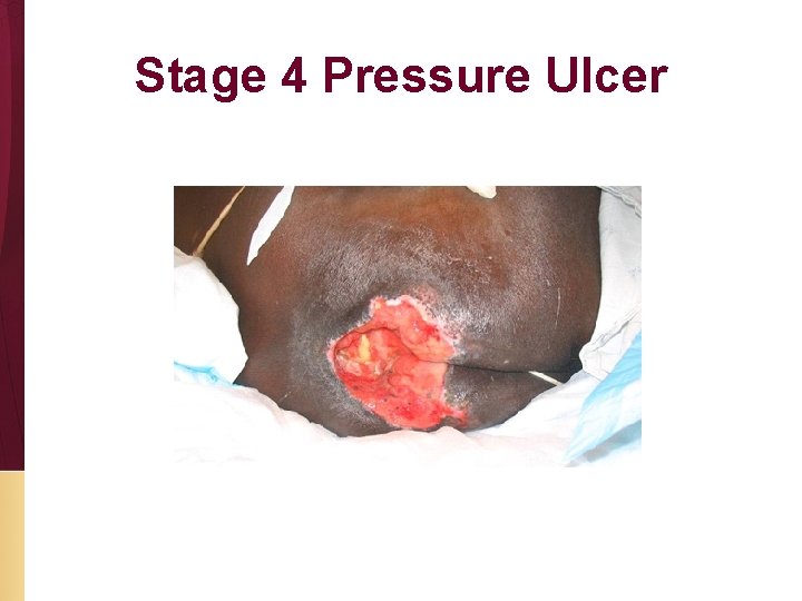 Stage 4 Pressure Ulcer 