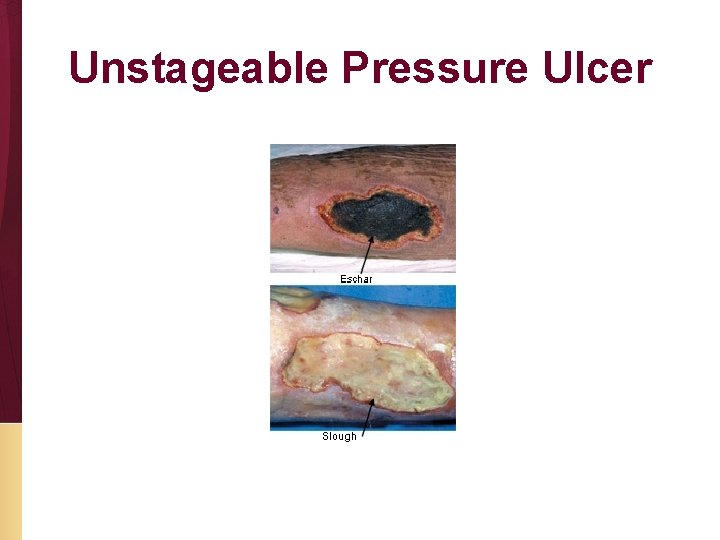 Unstageable Pressure Ulcer 