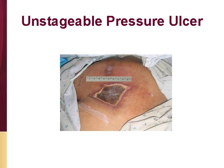 Unstageable Pressure Ulcer 