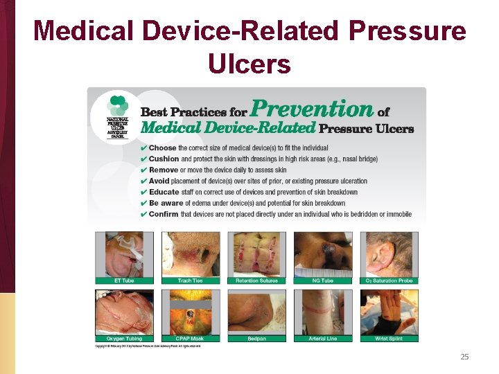 Medical Device-Related Pressure Ulcers 25 