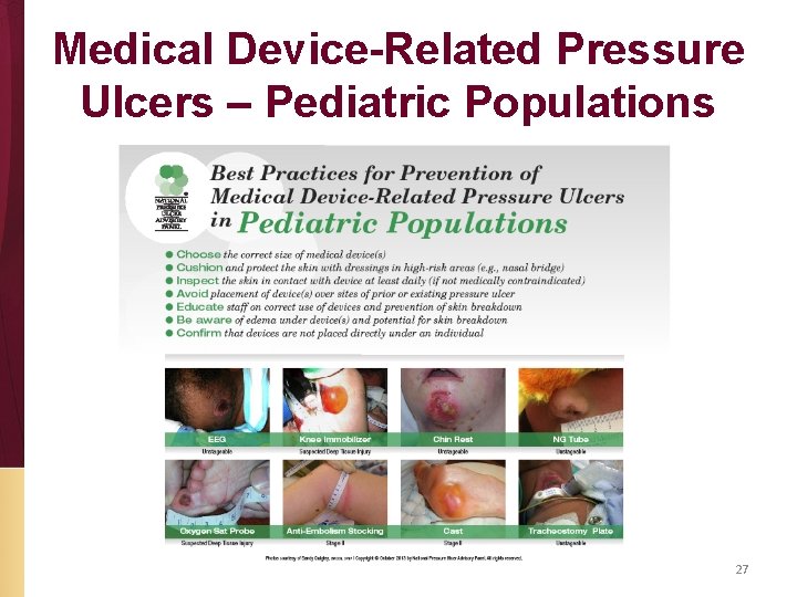 Medical Device-Related Pressure Ulcers – Pediatric Populations 27 