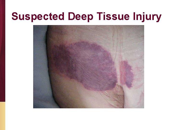 Suspected Deep Tissue Injury 