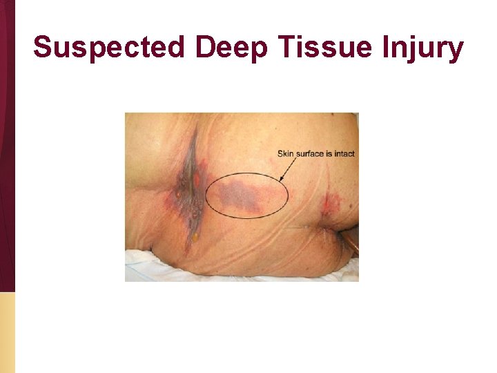 Suspected Deep Tissue Injury 