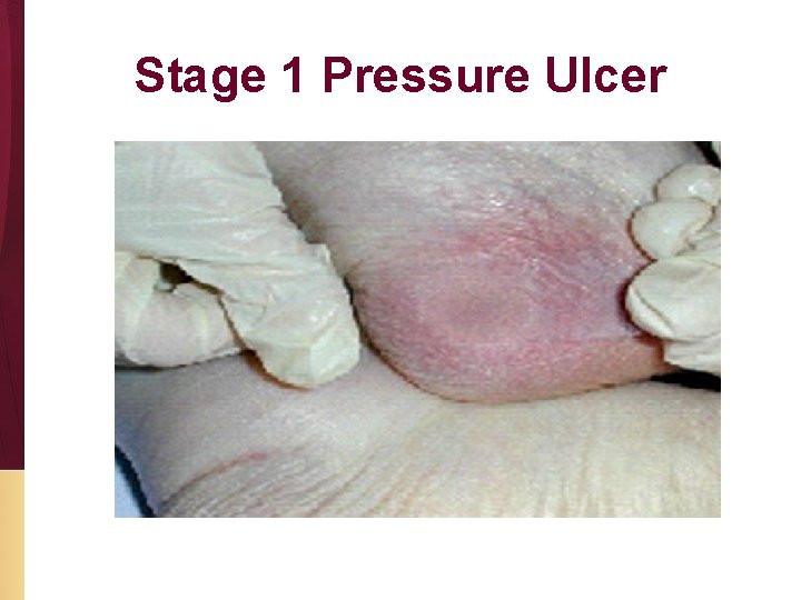 Stage 1 Pressure Ulcer 