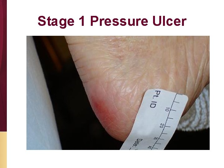 Stage 1 Pressure Ulcer 