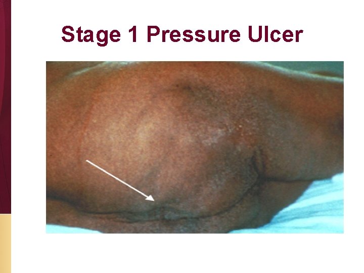 Stage 1 Pressure Ulcer 