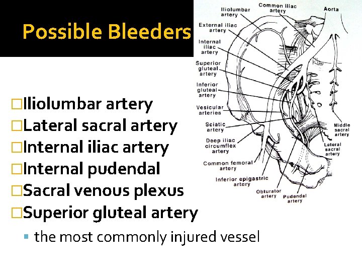 Possible Bleeders �Iliolumbar artery �Lateral sacral artery �Internal iliac artery �Internal pudendal �Sacral venous