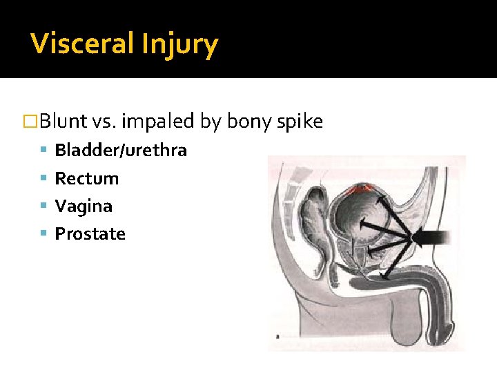 Visceral Injury �Blunt vs. impaled by bony spike Bladder/urethra Rectum Vagina Prostate 