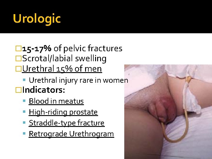 Urologic � 15 -17% of pelvic fractures �Scrotal/labial swelling �Urethral 15% of men Urethral