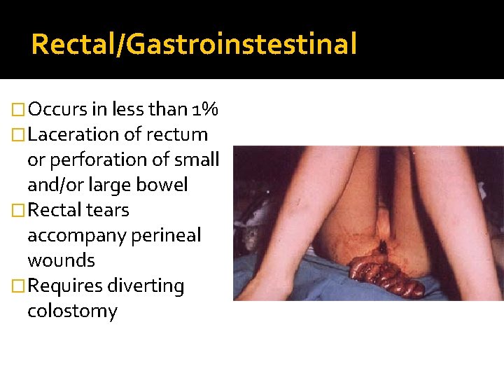 Rectal/Gastroinstestinal �Occurs in less than 1% �Laceration of rectum or perforation of small and/or
