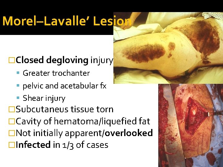 Morel–Lavalle’ Lesion �Closed degloving injury Greater trochanter pelvic and acetabular fx Shear injury �Subcutaneus