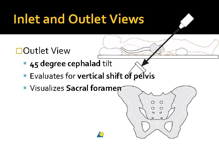 Inlet and Outlet Views �Outlet View 45 degree cephalad tilt Evaluates for vertical shift