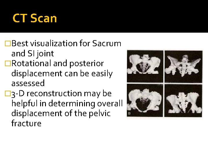 CT Scan �Best visualization for Sacrum and SI joint �Rotational and posterior displacement can